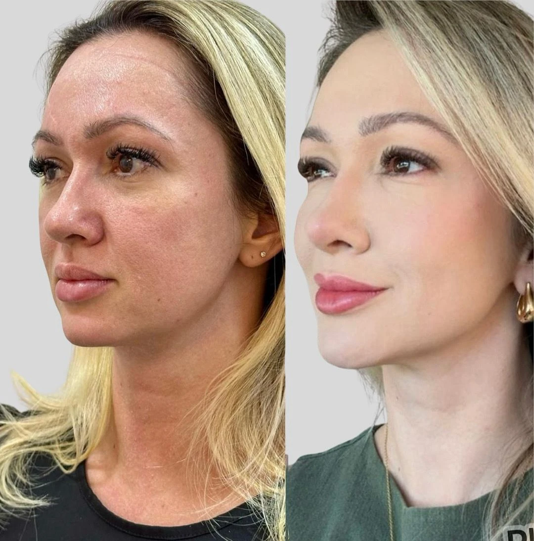 Antes e depois 1